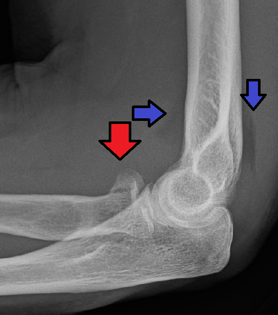 Elbow X-ray with arrows marking a radial head fracture and fat-pad signs