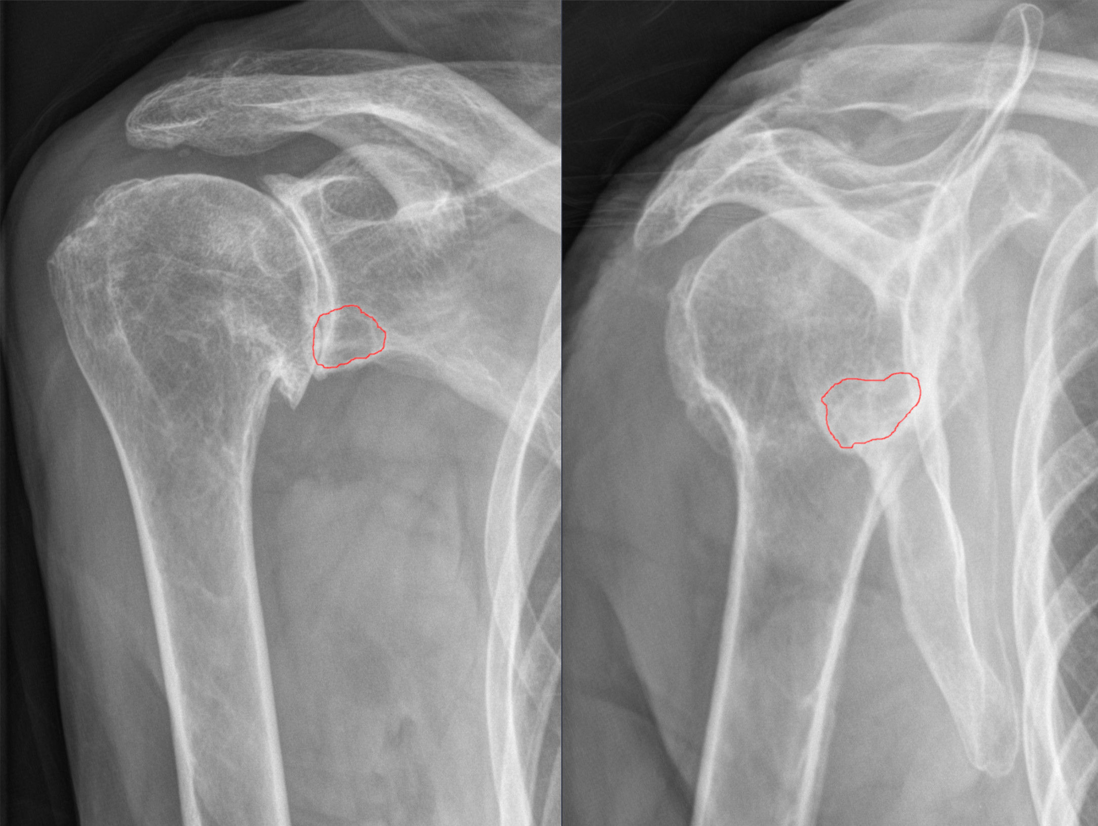 Two shoulder X-rays with arrows identifying osteoarthritis changes